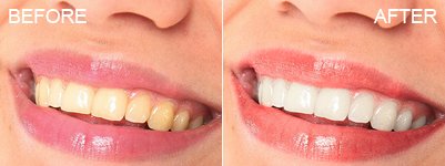 Whiten Teeth & Retouch Lips
